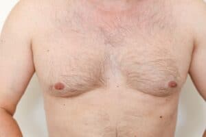Gynecomastia Candidates Denver