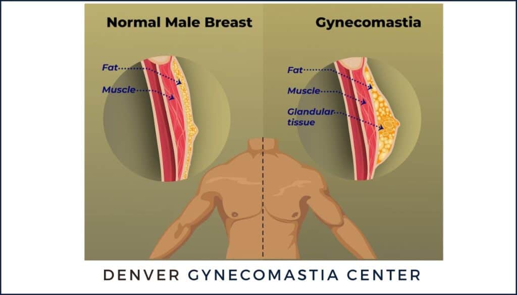 Gynecomastia Denver