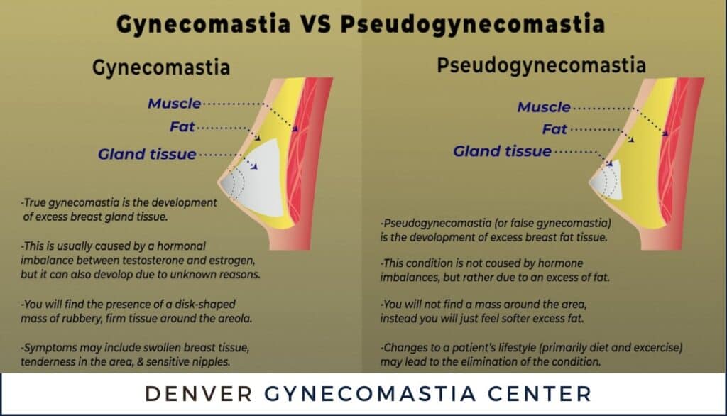 Pseudogynecomastia Surgery Denver
