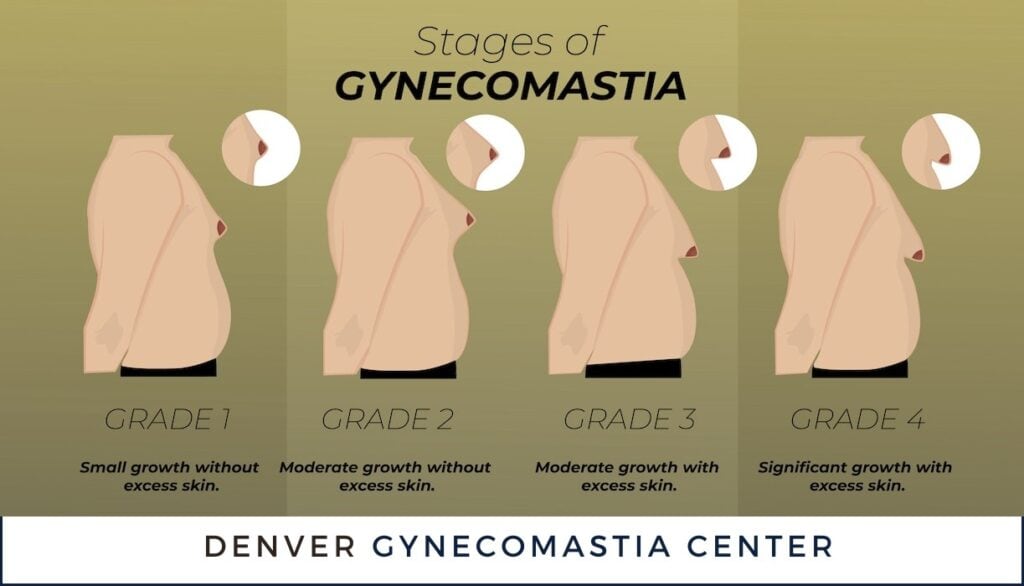 Stages and Grades of Gynecomastia